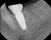Fig 14. A periapical radiograph of the custom healing abutment on the implant demonstrated the development of a natural emergence profile for a mandibular molar to replicate the missing natural tooth.