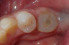 Fig 15. After healing, the gingiva around the emergence custom healing abutment was ready for initiation of the restorative phase of treatment.