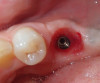 Fig 16. A natural emergence profile for a mandibular molar, square in cross-section, was developed as evidenced upon removal of the custom healing abutment.