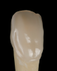 Fig 4. Lithium-disilicate crown with facial cut-back.