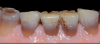 Fig 12. Discolored mandibular incisors.
