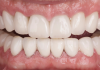 Fig 14. Discoloration masked with layered 3Y zirconia crowns.