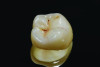 Fig 1. Monolithic zirconia crown with superficial staining.