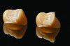 Fig 2. Full-contoured monolithic zirconia crown (left) and monolithic zirconia crown with facial cutback design (right) after milling.