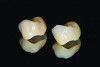 Fig 3. The crowns from Figure 2, finalized and glazed.