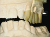 Fig 6. All-ceramic, bilayered fixed dental prostheses with occlusal contacts on zirconia in maximum intercuspation position and excursive movements.