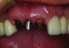 Fig 7. Stump shades should be communicated using a stump shade guide when restoring teeth with all-ceramic restorations.