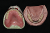 Fig 2. Overdenture prosthesis prior to laboratory processing showing denture teeth suspended in baseplate wax. The prosthesis at this stage is removable and tried onto the edentulous ridge permitting verification of esthetics, tooth position, and centric.