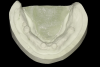 Fig 5. Stone case with stud-style housings incorporated into the stone, which permits the technician to process acrylic resin to the shape of the housings in the intaglio surface of the prosthesis.