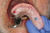 Fig 10. Completed laboratory processed implant-assisted removable partial denture.