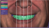 Fig 5. Occlusal cants can be verified and altered to the natural head position with grid lines to ensure the proper position of the teeth in the face.