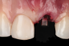 Fig 2. Immediate view of the implant and frictional abutment installed on the day of surgery.