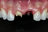 Fig 3. Intraoral view 3 months after implant installation.