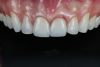 Fig 5. Conventional zirconia try-in under different light scenarios: Fig 5 = natural light, Fig 6 = ultraviolet light, Fig 7 = polarized filter.