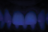 Fig 6. Conventional zirconia try-in under different light scenarios: Fig 5 = natural light, Fig 6 = ultraviolet light, Fig 7 = polarized filter.