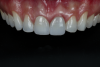 Fig 8. Monolithic zirconia try-in under different light scenarios: Fig 8 = natural light, Fig 9 = ultraviolet light, Fig 10 = polarized filter.