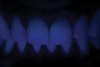 Fig 12. Minimally veneered monolithic zirconia (cut-back technique) try-in under different light scenarios: Fig 11 = natural light, Fig 12 = ultraviolet light, Fig 13 = polarized filter.