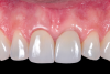 Fig 15. Clinical appearance of the achieved pink and white esthetics at follow-up at 32 months.