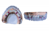 Fig 3. Digital design of the maxillary bar and suprastructure
framework is performed to ensure the prosthesis guides the
technician. The bar is designed in a way that it is hygienic
and strong enough according to the desired restorative
material.