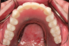 Fig 5. The bar overdenture is processed
conventionally and retentive elements placed at the laboratory.
The prosthesis is placed together with the bar and
patient confirmation of esthetics, phonetics, and centric.