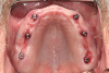 Fig 6. The patient presents with six existing LOCATOR R-Tx abutments (Zest Dental Solutions) in
place.