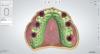 Fig 8. Optical
scans are imported into dental-specific software and framework designed to ensure as much palatal
coverage as possible is achieved and retentive meshwork surrounding abutment housings