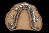 Fig 9. Completed maxillary framework is 3D
printed by an industrial laboratory (Bertram
Dental in Menasha, Wisconsin).