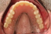 Fig 10. The studstyle
overdenture is processed conventionally
and retentive elements attached chairside upon
delivery of the prosthesis by the clinician.