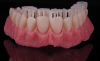 Fig 6. The relevance of the strength of the base has been questioned because the tooth could de-bond from the base prematurely, but a fusing technique can be utilized to permanently link the tooth structure to the denture base.