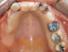 Fig 1. Initial occlusal view of maxillary arch.