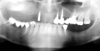 Fig 2. Initial panoramic radiograph.