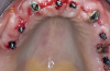 Fig 3. Maxillary arch after placement of TIs.