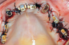 Fig 5. Maxillary arch with modular copings over the TIs after TI bar was removed.