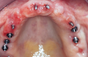 Fig 8. Maxillary arch after removal of provisional, with the healing uneventful.