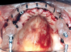 Fig 10. Occlusal view showing use of surgical guide for implant placement.