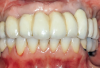 Fig 11. Frontal view after insertion of laboratory-processed maxillary fixed provisional restoration into implants Nos. 2, 3, 4, 13, and 14.