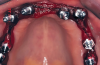 Fig 13. Maxillary arch with impression copings splinted for final impression.