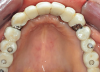 Fig 15. Maxillary arch with final prosthesis.