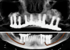 Fig 19. CBCT at 20-year follow-up.