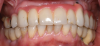 Fig 20. Frontal view at 20-year follow-up.