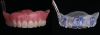 Fig 2. Prosthetic space measured from the soft-tissue height of the edentulous ridge to the occlusal surface of the opposing dentition across the arch.