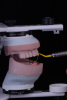 Fig 3. Prosthetic space measured using millimeter probe on mounted casts.