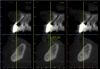 Fig 4. Radiographic measurements to establish the amount of prosthetic space available; these measurements aid in planning prosthetic space and implant placement. Fig 4 demonstrates a method to measure the apico-coronal dimensions of the restorative prosthesis. Fig 5 allows for assessment of the implant position planned based on radiographic bone volume and prosthesis positions.