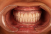 Fig 10. Transition line can be seen between maxillary implant-supported prosthesis and residual soft-tissue crest.