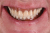 Fig 2. Patient has excessive gingival display of the existing prostheses.
