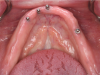 Fig 3. Pretreatment situation showing edentulous lower ridge and four existing mini implants.