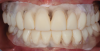 Fig 7. The new restorative set-up is 3D-printed in a split file: one file for the denture base and another for the teeth. This allows the clinician to use clear resin at the base to determine the relationship of teeth to edentulous ridge and the need to use pink in the final prosthesis.