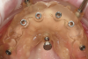 Fig 8. The surgical guide for the maxilla is constructed to be tissue-supported and retained by fixation pins. Restorative set-up is used to ensure the implant’s position is restoratively driven.