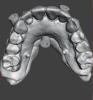 Fig 9. The surgical guide for the maxilla is constructed to be tissue-supported and retained by fixation pins. Restorative set-up is used to ensure the implant’s position is restoratively driven.