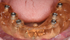 Fig 10. The surgical guide for the mandible is created to be supported by existing mini implants.